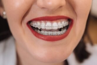 Braces Cause Gum Recession