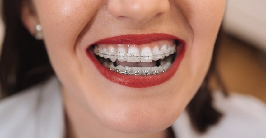 Braces Cause Gum Recession