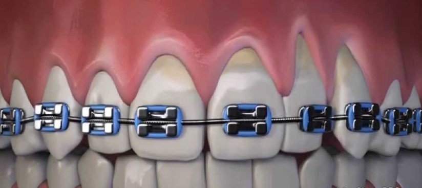 Braces and Gum Recession
