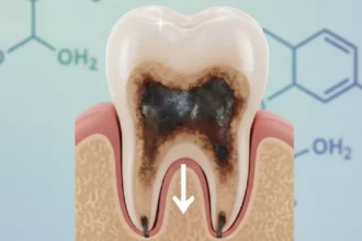 Sugar Alcohols and Tooth Decay